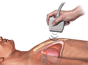 Echocardiogram