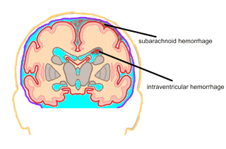 Types of bleeding in the brain