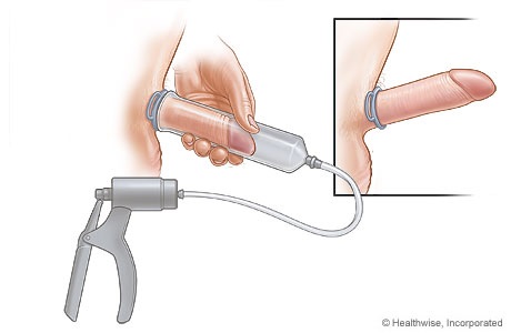 Picture of a vacuum device for erection problems