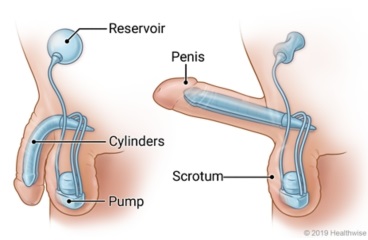 Picture of a penile implant